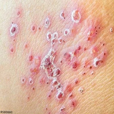 急性荨麻疹如何检查 做这几个检查了解急性荨麻疹情况