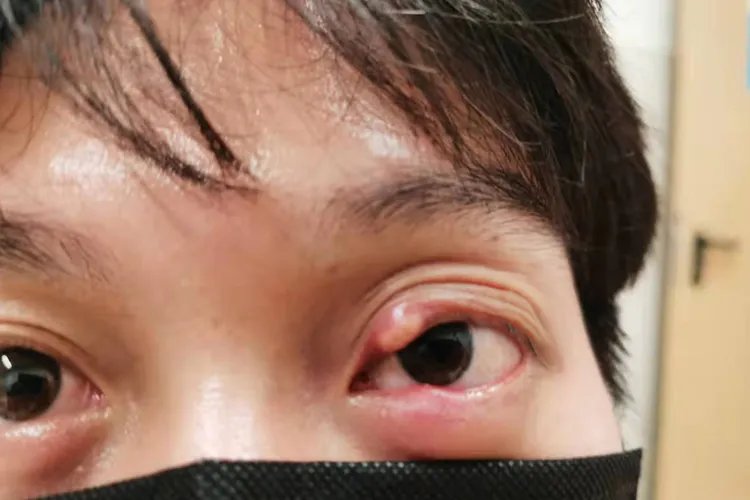 麦粒肿是什么样的