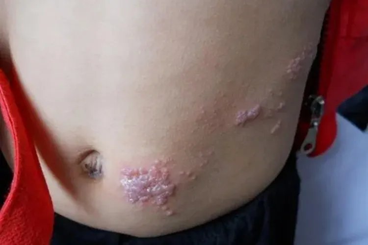 带状疱疹照片是什么样子的