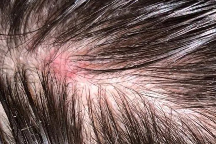 头皮脂溢性皮炎图片