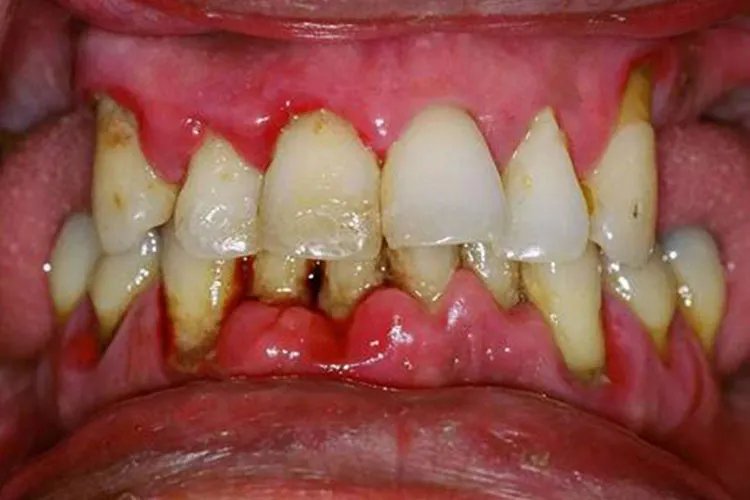 牙龈癌的早期三大症状图片