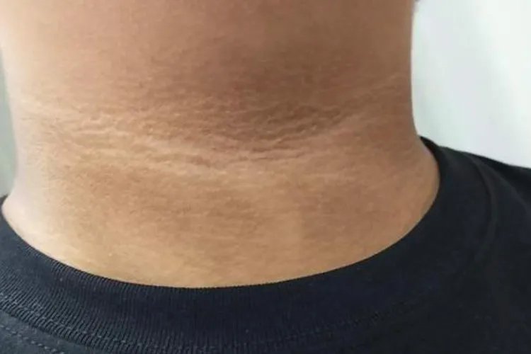 黑皮病症状图片