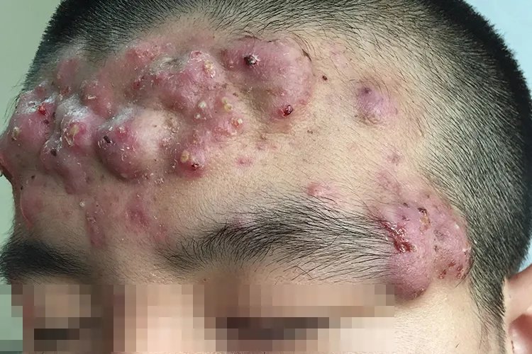 最严重的痤疮图片