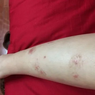 什么是牛皮癣？