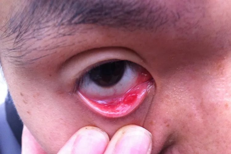 麦粒肿是什么样的