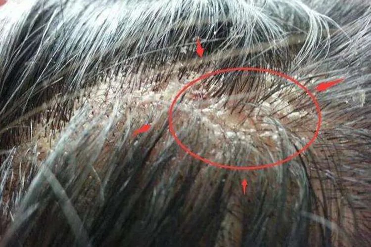 头皮脂溢性皮炎图片