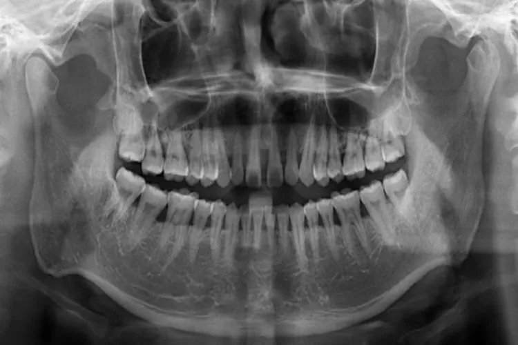 牙槽骨长什么样子图片