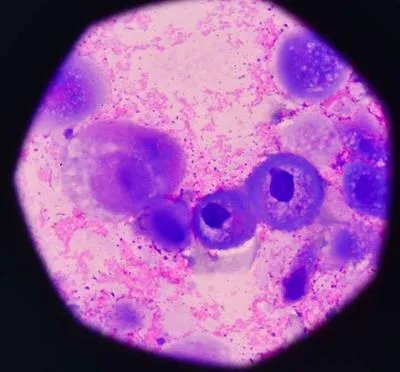 肺炎疫苗有副作用吗 了解接种肺炎疫苗三个副作用