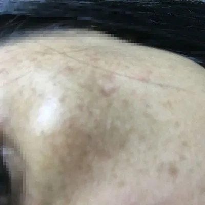 怎么消除日晒斑？