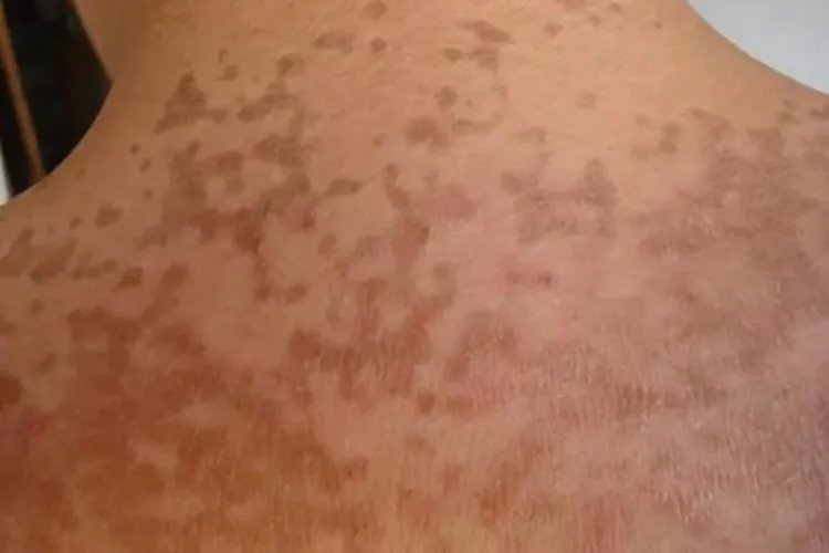 融合性网状乳头瘤病背部斑图片