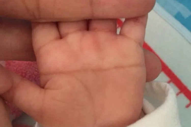 5P-综合征手掌纹图片