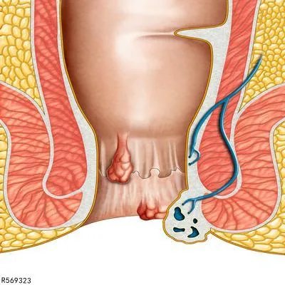 肛检前需要做什么准备