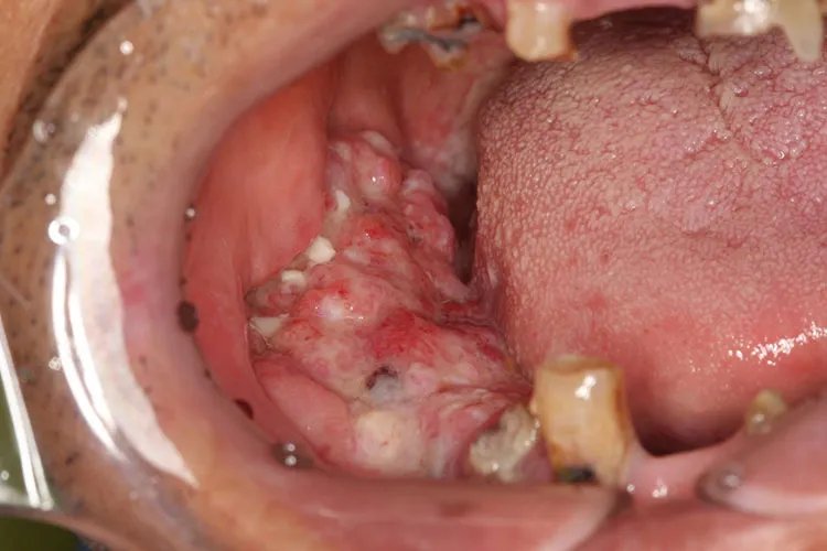 牙龈癌的早期三大症状图片