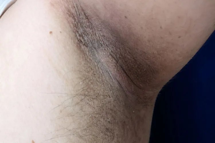 黑皮病症状图片