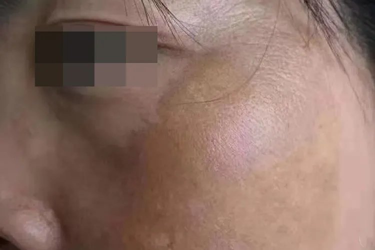 脸上斑的图片及分类图片