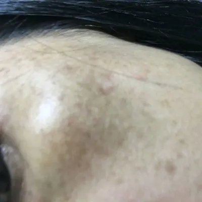 怎么消除日晒斑？