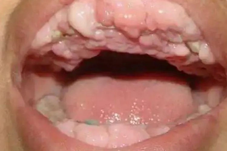 牙龈癌的早期三大症状图片