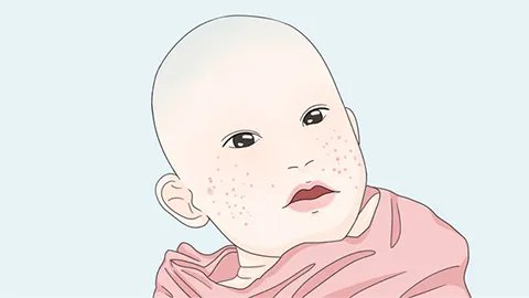 热痱子怎么治好得快