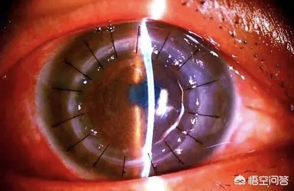 有没有可能利用打印3d角膜进行角膜移植来治疗近视?