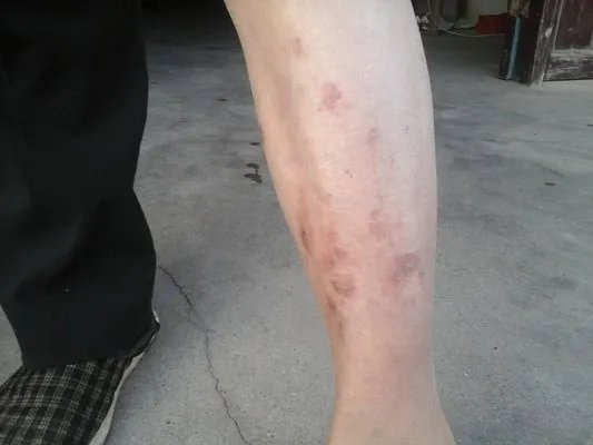 什么是牛皮癣？