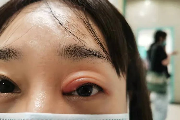 麦粒肿是什么样的