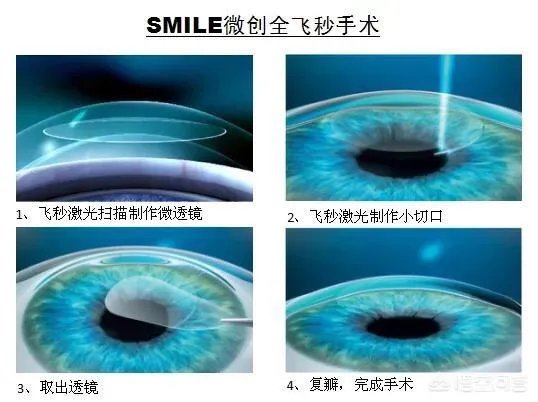 有没有可能利用打印3d角膜进行角膜移植来治疗近视?