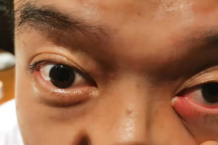 麦粒肿是什么样的