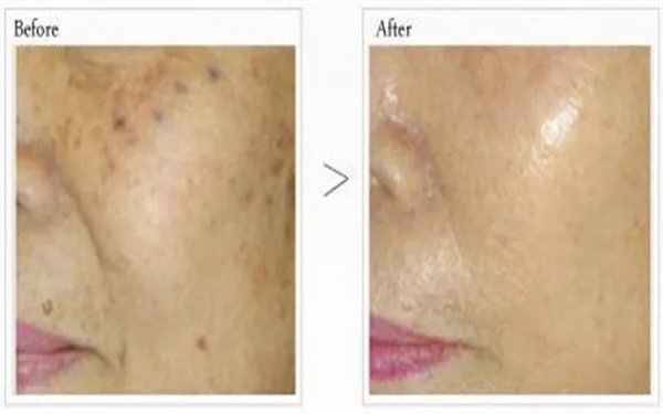 老年斑消除方法