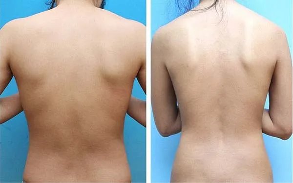 背部吸脂多少钱