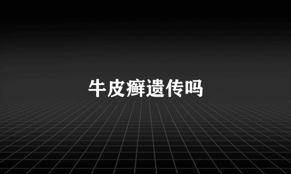 牛皮癣遗传吗