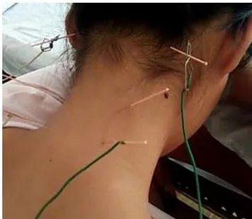 女子针灸电疗瘫痪是怎么回事?