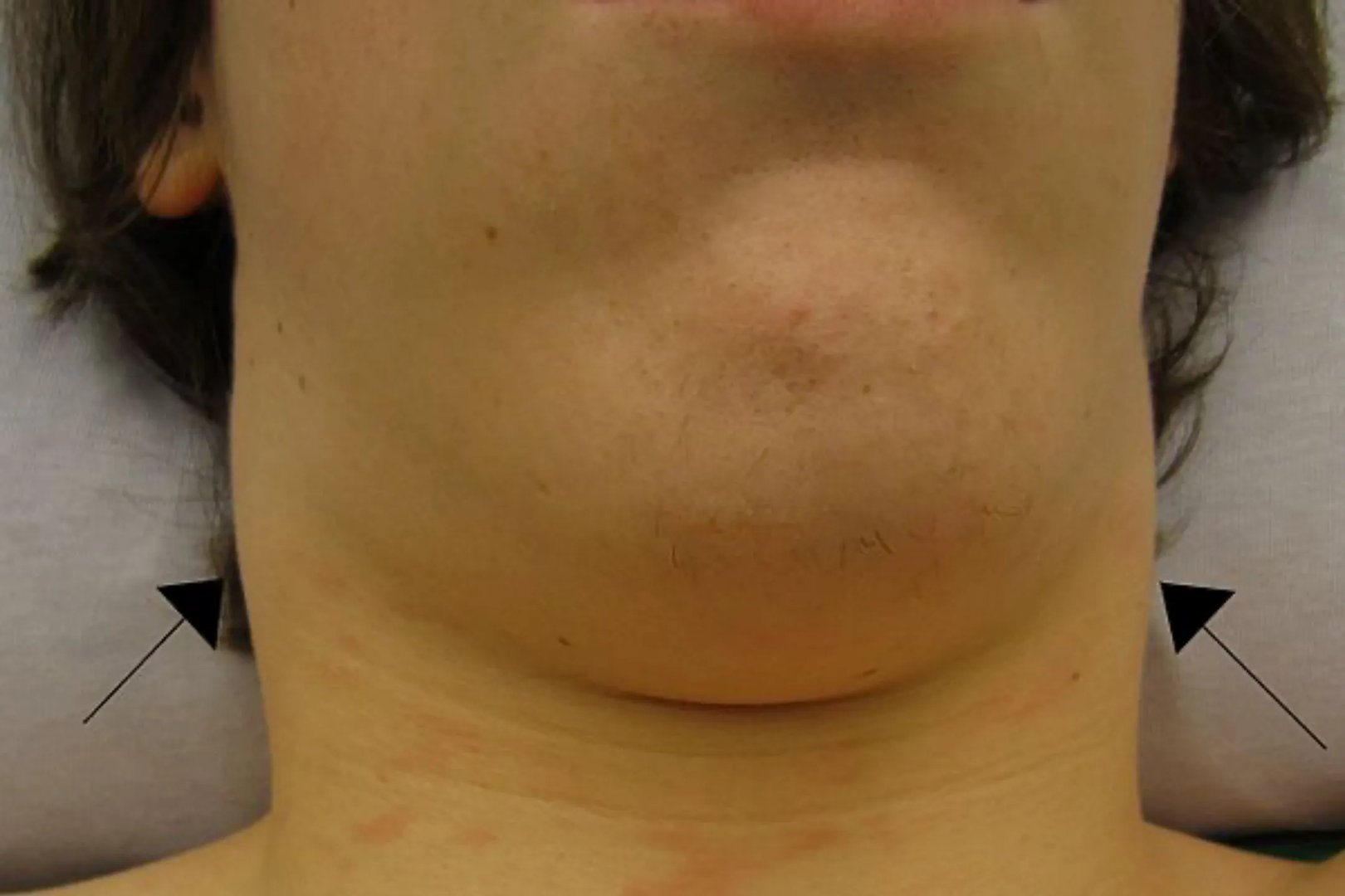 脖子咽喉处有肿块图片