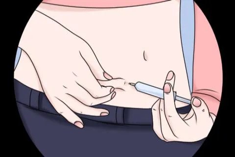 胸腺法新的注射部位图解