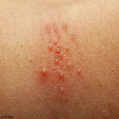 毛囊炎痒用什么药 毛囊炎痒可用四种药止痒