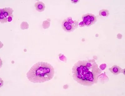 血小板减少性紫癜是什引起的