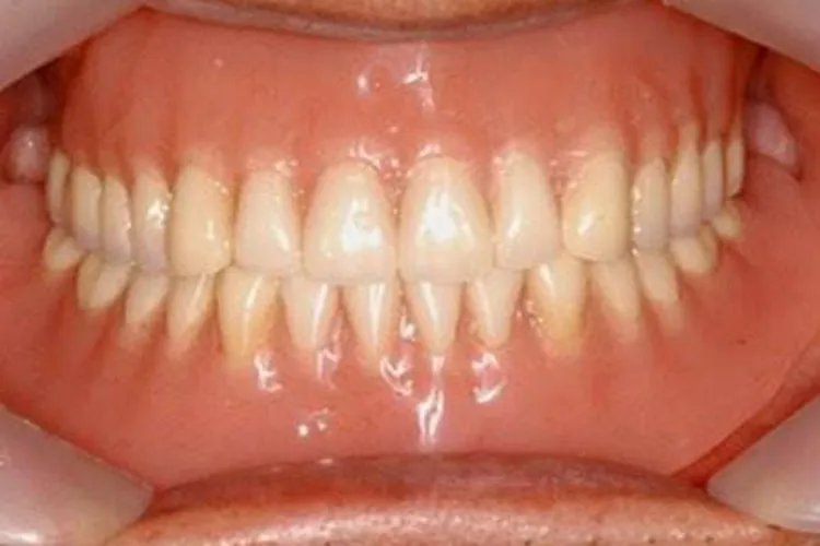 牙槽骨长什么样子图片