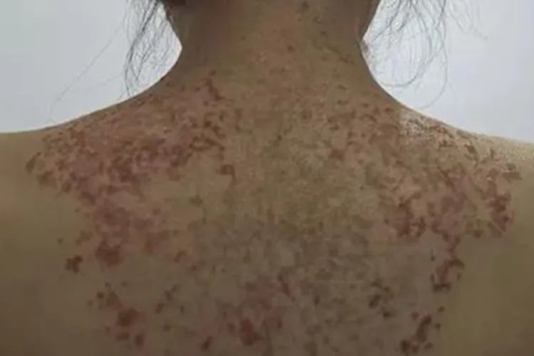 融合性网状乳头瘤病背部斑图片