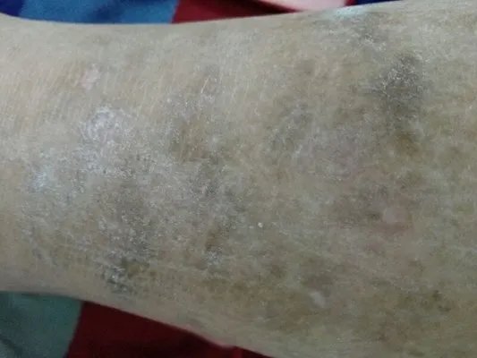 什么是牛皮癣？