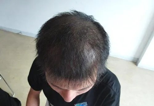 艾福杰尼谢广坤同款秃头笑翻全场，你如何看待年轻人秃头问题？