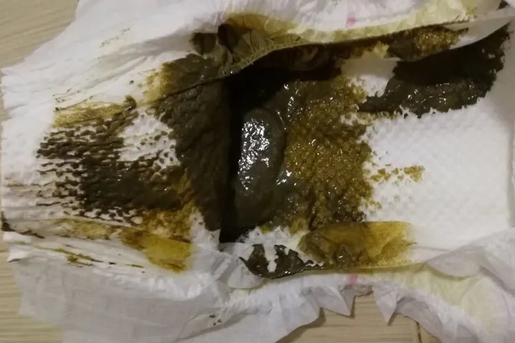 新生儿正常大便图片