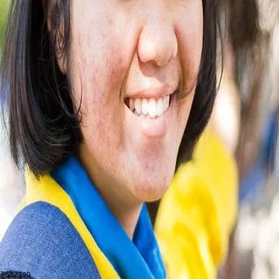 面部红血丝怎么修复快