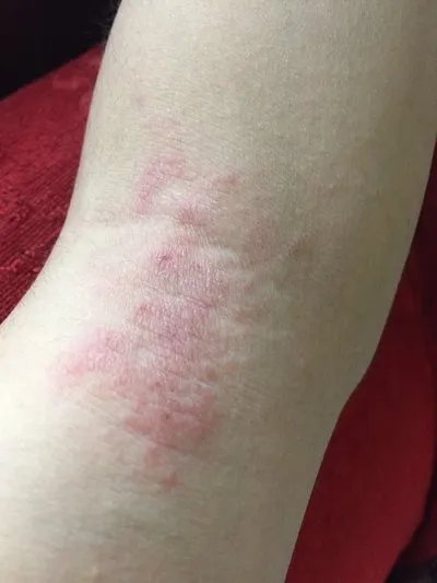 脂溢性皮炎症状？