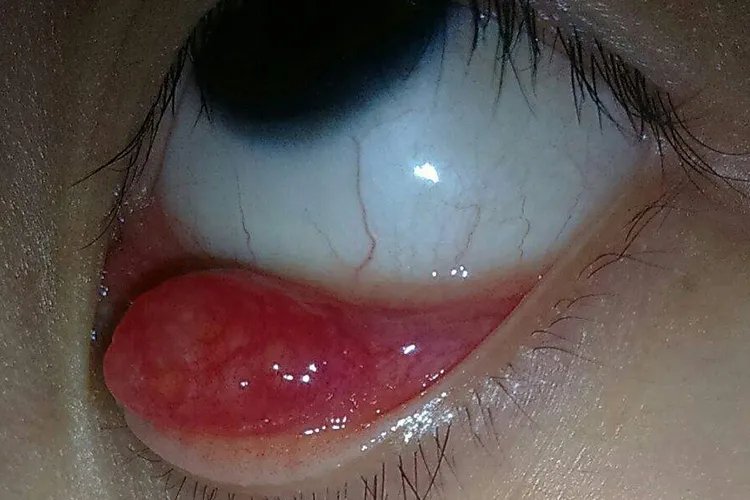 麦粒肿是什么样的