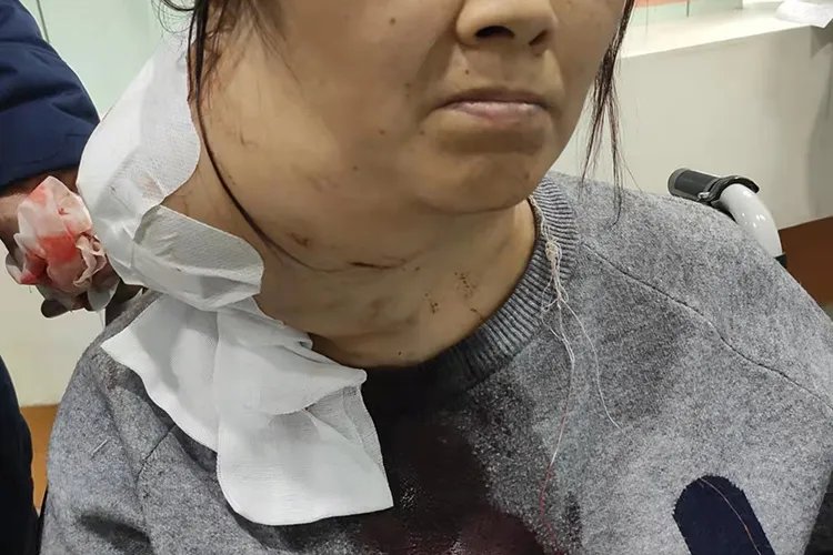 甲状腺肿大图片