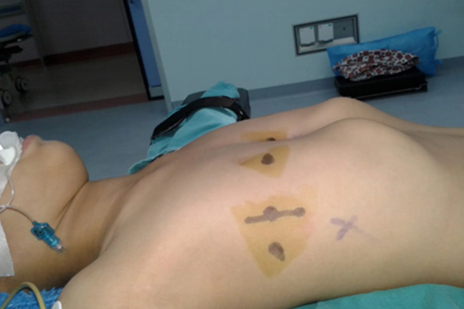 正常人和鸡胸平躺图片