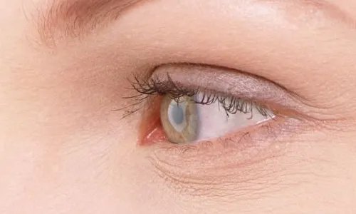 三点式双眼皮好吗