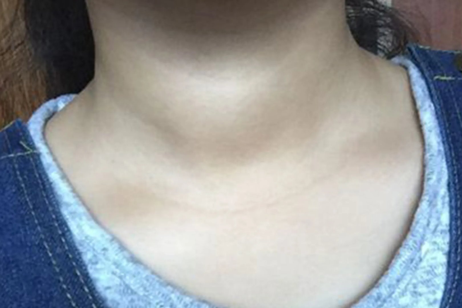 脖子咽喉处有肿块图片